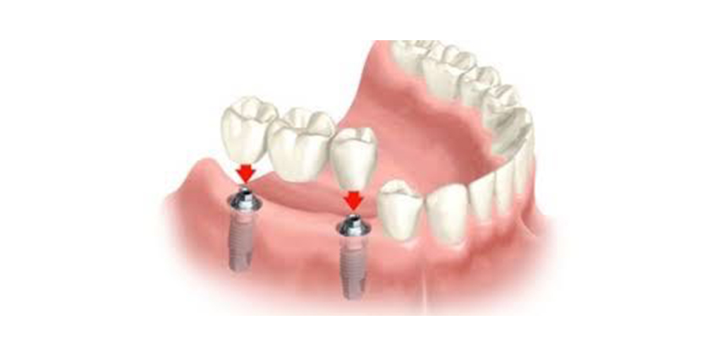 Implante Dentário Prótese fixa sobre implante